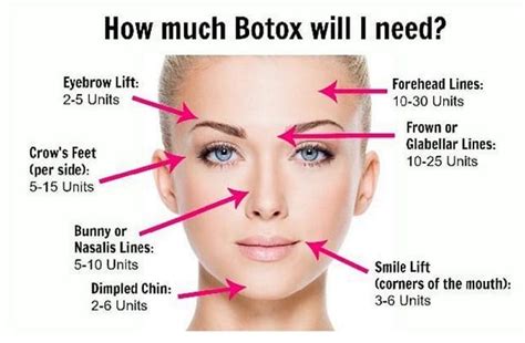 Neck Bands 25 to 50 Units. . How many units of botox is in one syringe